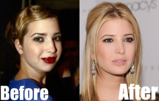 Ivanka-Trump-Plastic-Surgery-Before-and-After.jpg