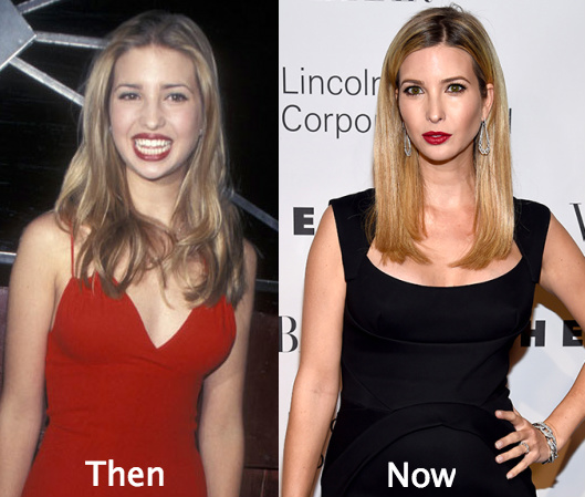 Ivanka-Trump-Plastic-Surgery-Before-and-After (1).jpg