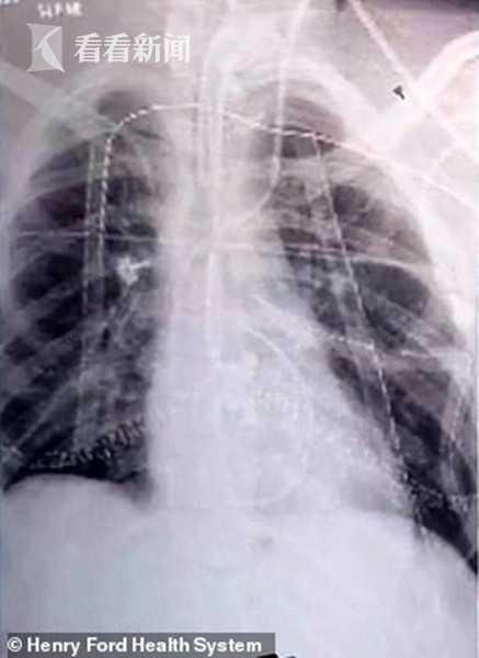 17岁少年双肺坏死插管濒亡 医生：吸电子烟的下场